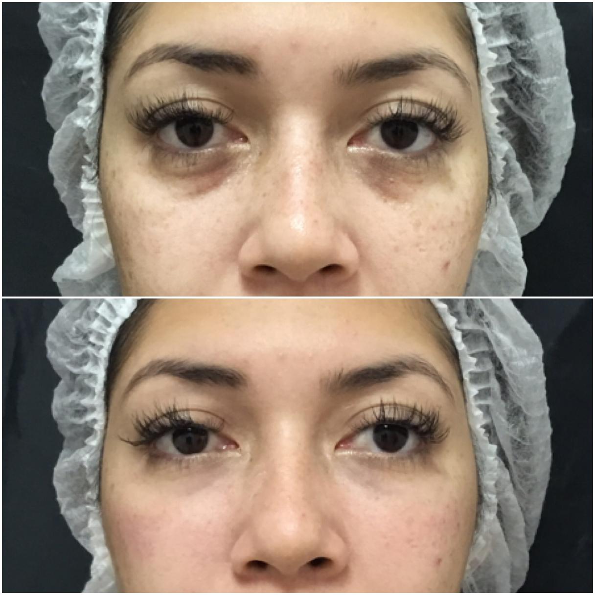 laser para olheiras vasculares valor