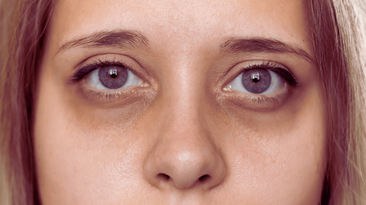 peeling químico olheiras preço