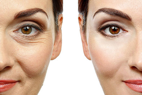 custo preenchimento olheiras ácido hialurônico