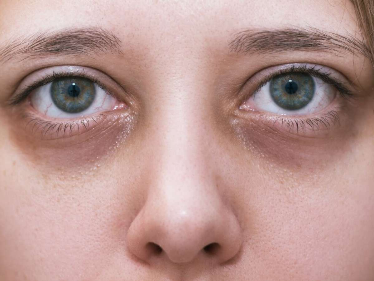 Melhores tratamentos para olheiras profundas e escuras