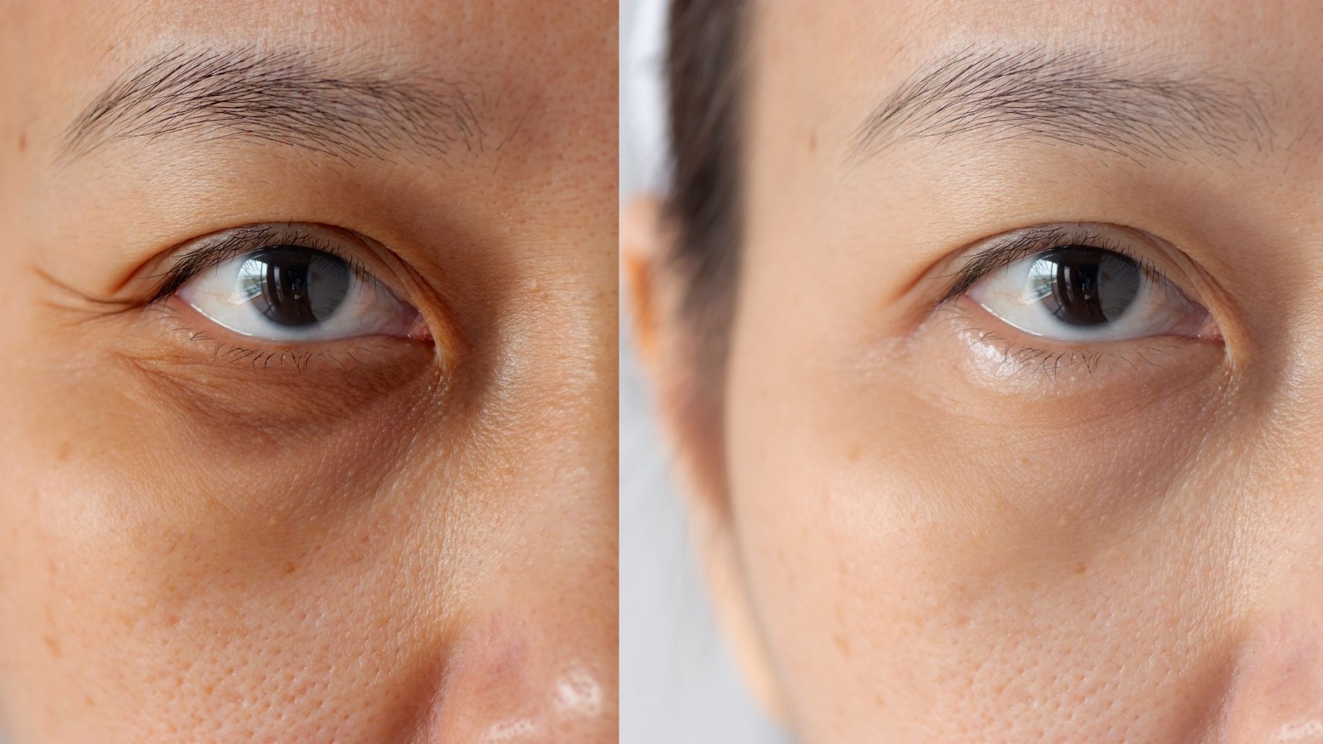 creme para olheiras pigmentares