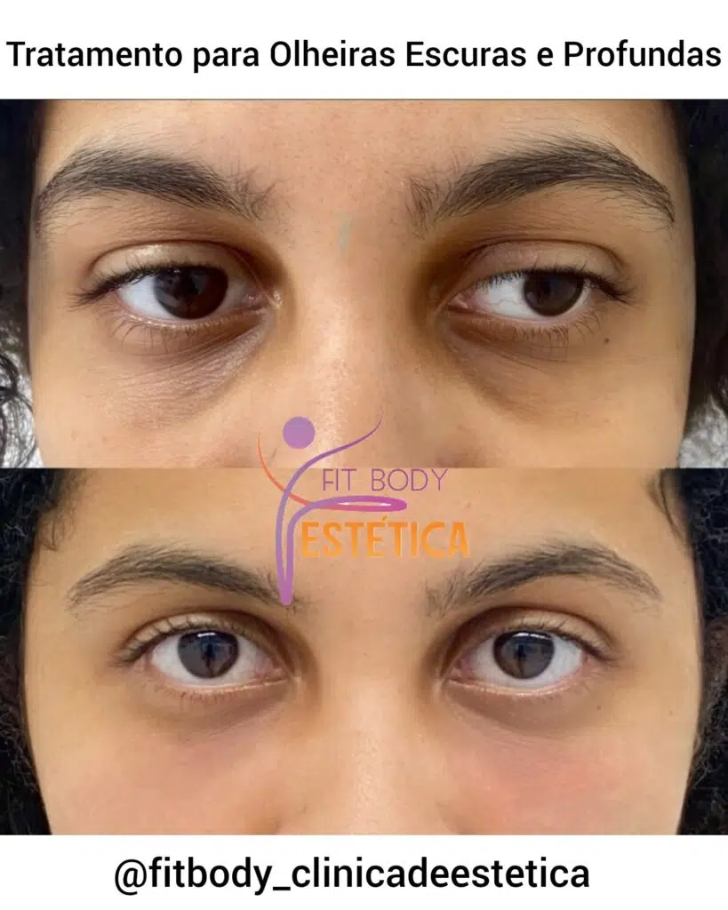 laser para olheiras vasculares valor