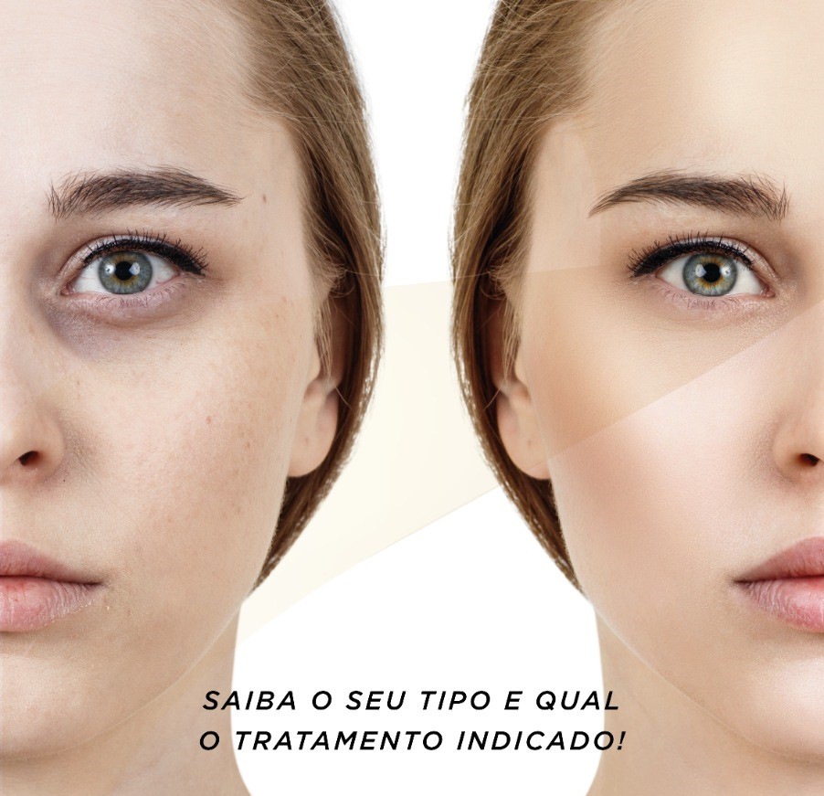 peeling químico olheiras preço