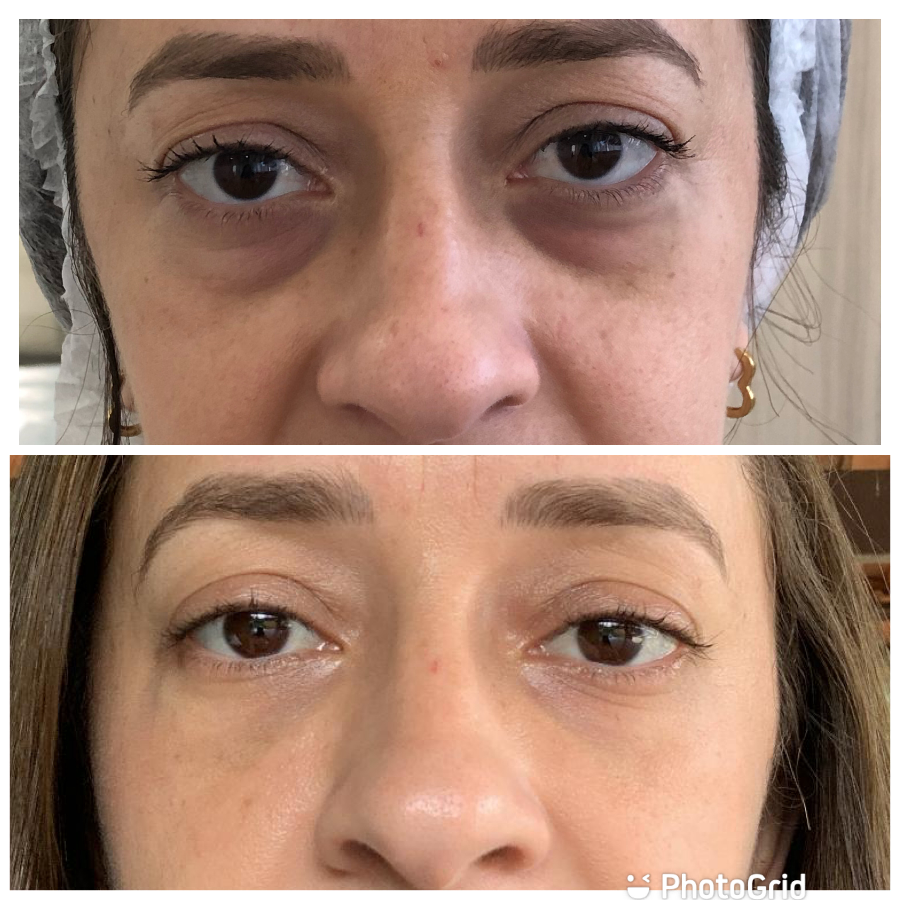 cafeína vitamina k olheiras