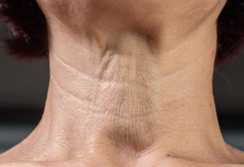 tratamentos para flacidez no pescoço