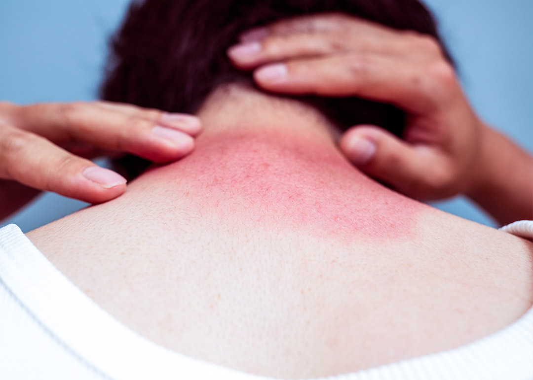 recuperação da pele após queimadura solar