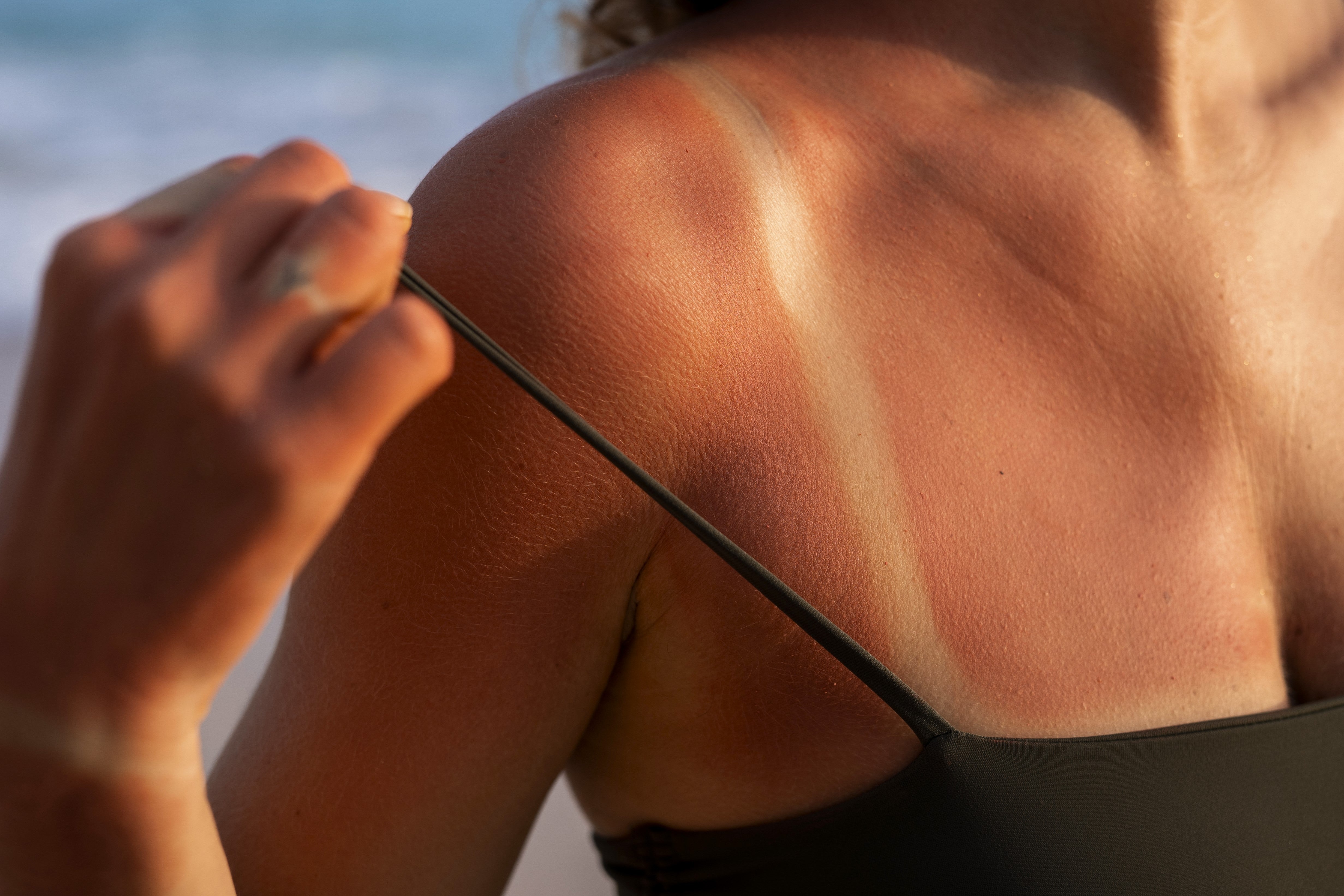 Skincare pós-sol: como recuperar a pele queimada