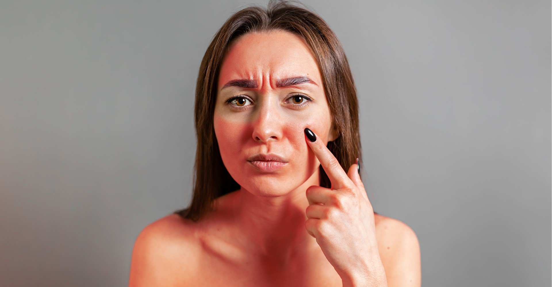 o que fazer para queimadura de sol