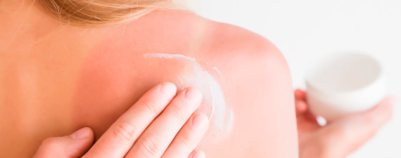 cuidados com a pele após exposição solar