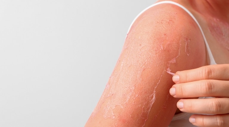 aliviar ardência da queimadura de sol