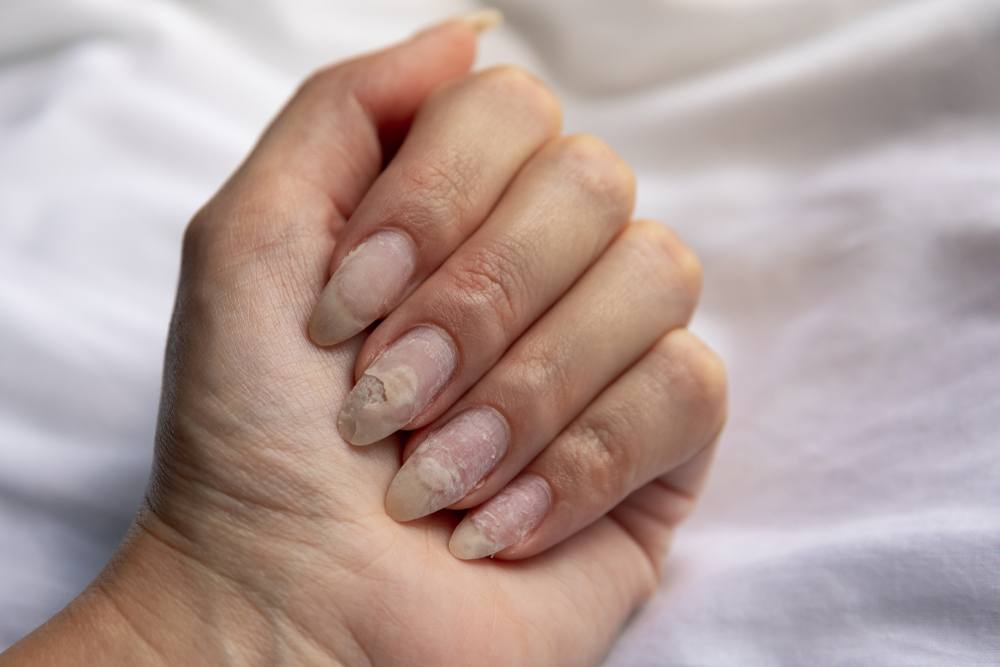 unhas quebradiças