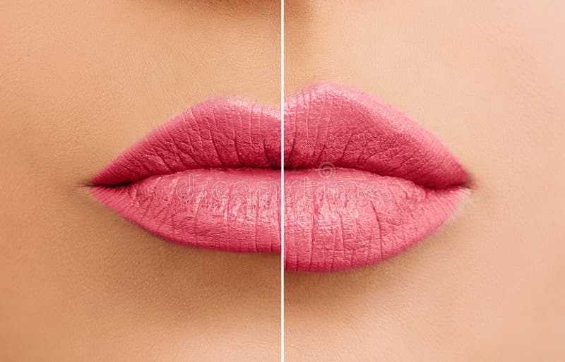 melhor preenchimento labial