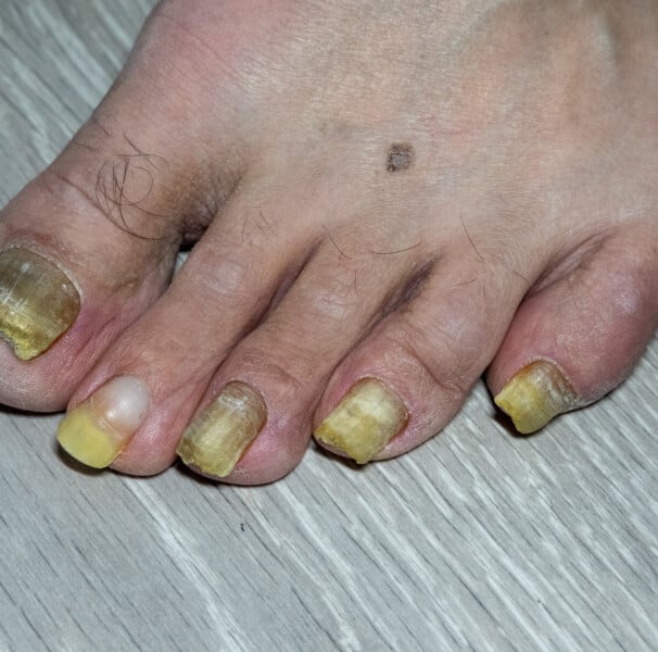 unha amarelada é micose ou esmalte