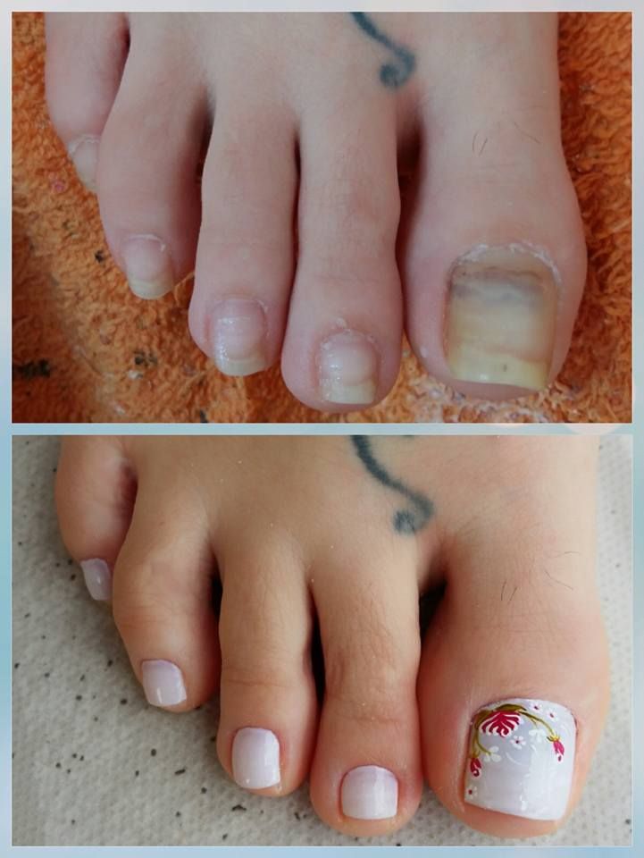 unhas acrílicas brilhantes pé