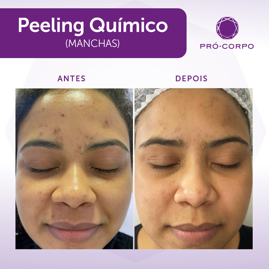benefícios peeling químico
