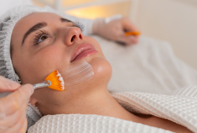 peeling químico para melasma