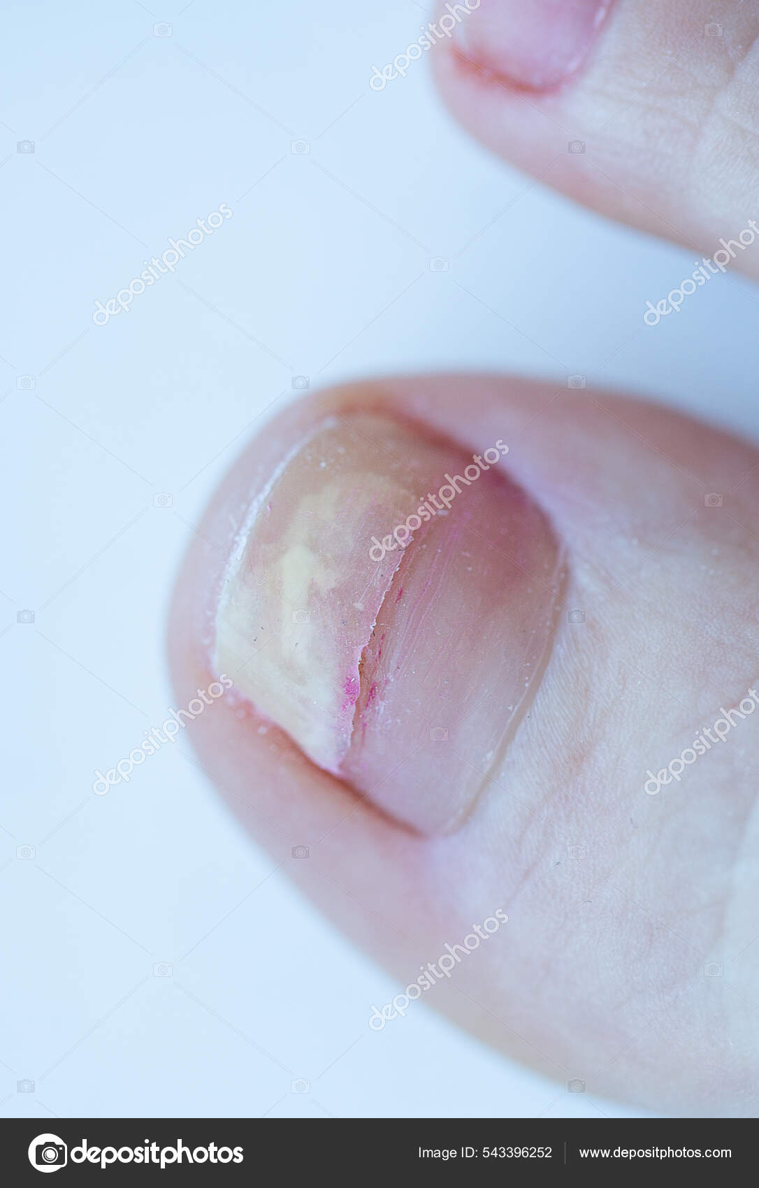 unhas rachadas